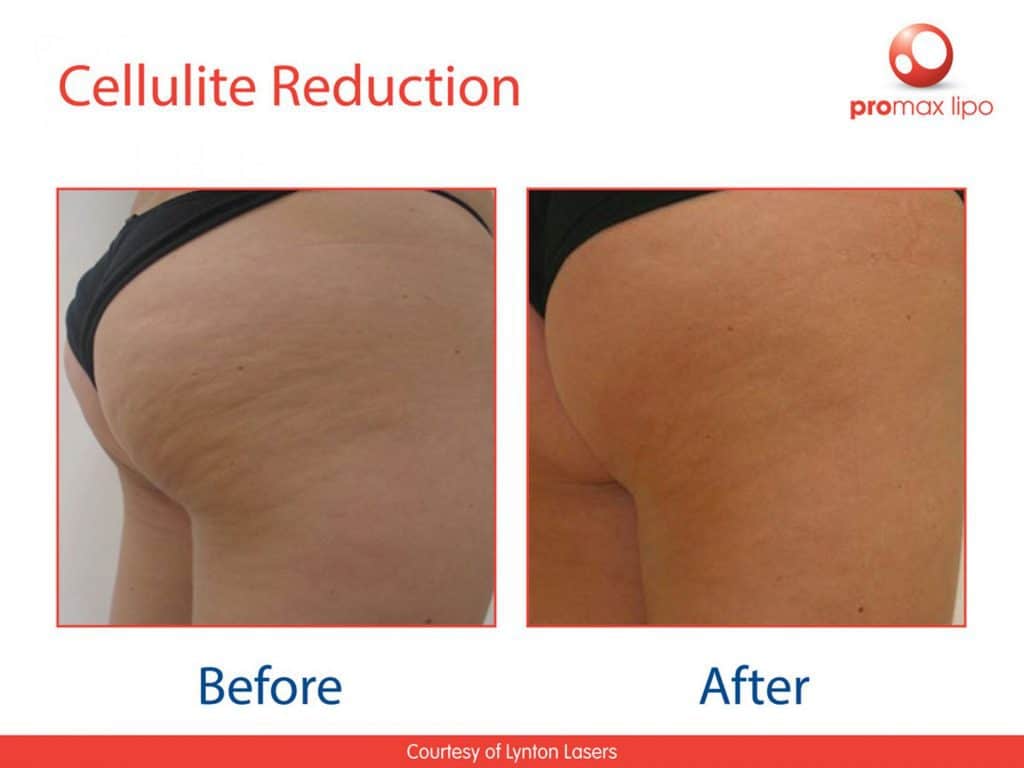 Microwaves in the treatment of cellulite • Lynton Lasers