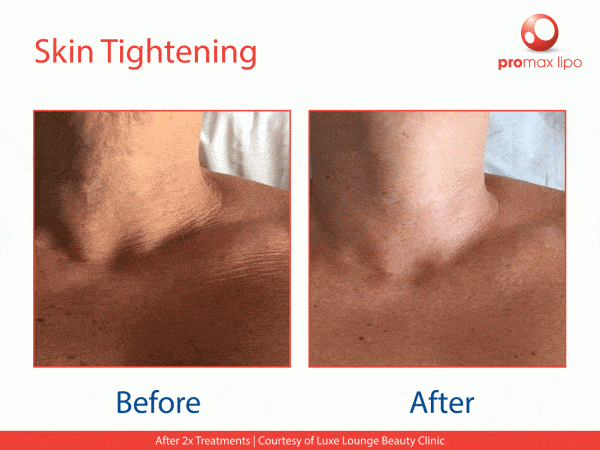 radio frequency facial slimming