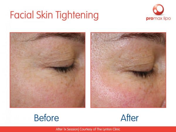 rf face tightening