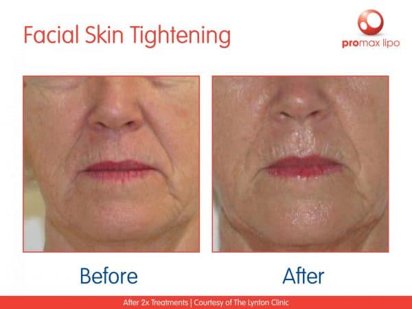 radio frequency face before and after