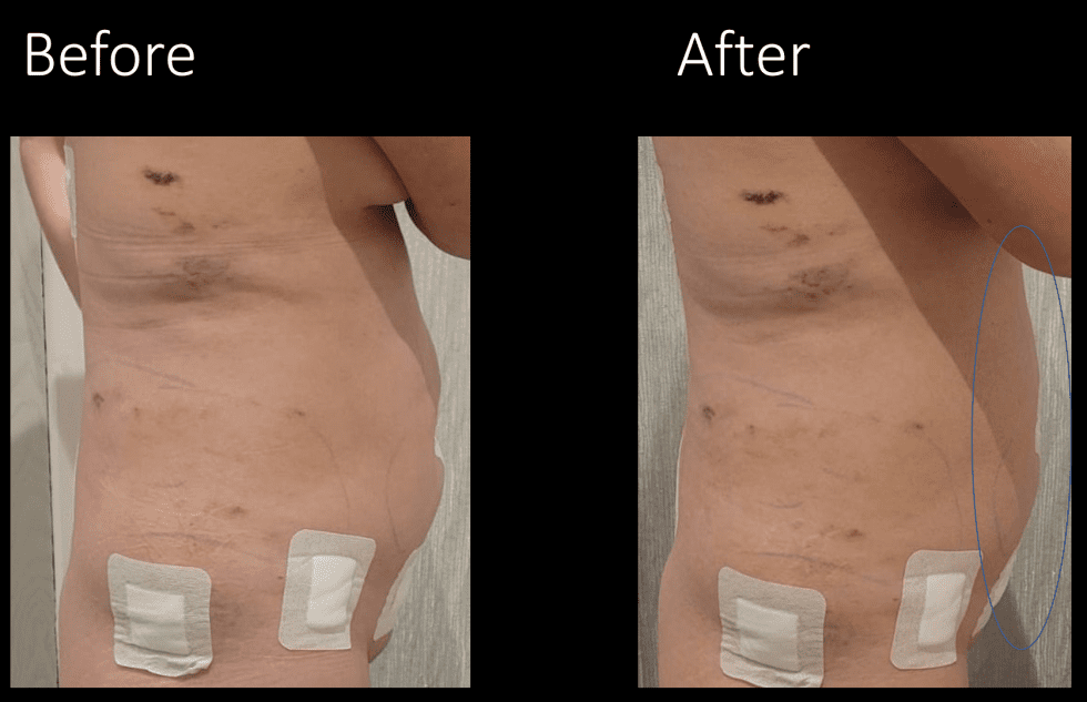 how-long-does-it-take-to-recover-from-lipo-360-07757-946023